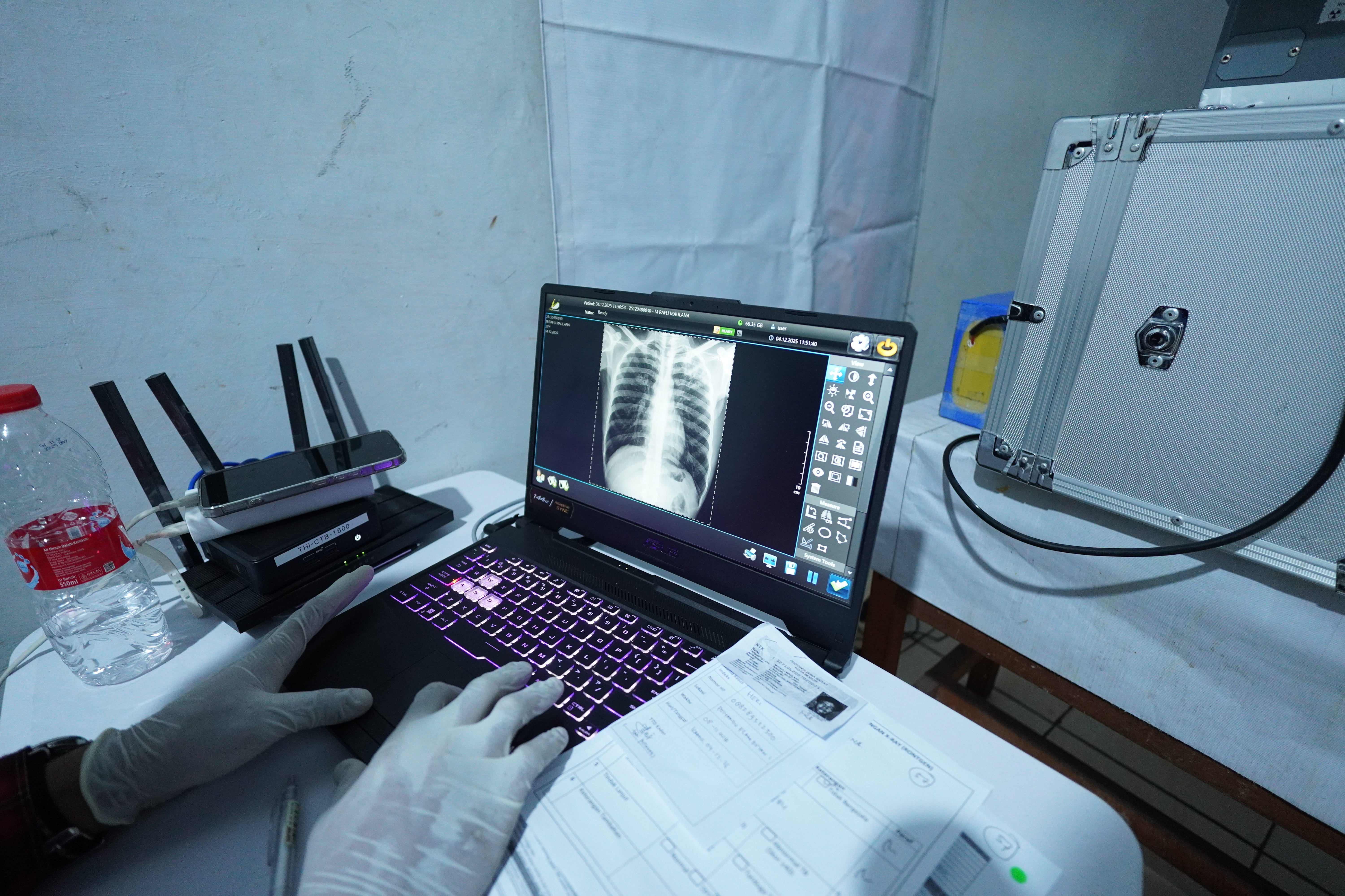 TB Screening with Portable X-ray